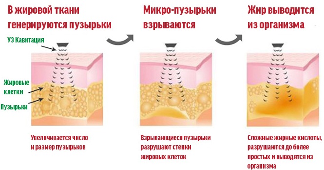 Μη χειρουργική λιποαναρρόφηση της κοιλιάς. Φωτογραφία πριν και μετά το λέιζερ, υπέρηχος, κριτικές, τιμή
