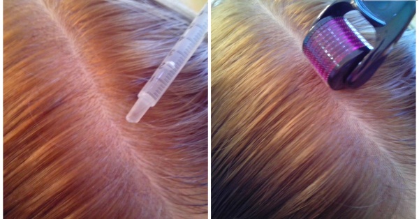 Dermahil για τα μαλλιά στη μεσοθεραπεία. Σύνθεση, φωτογραφίες πριν και μετά, οδηγίες χρήσης