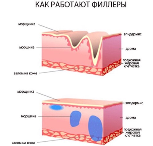 Περίγραμμα πλαστελίνης της ρινοσακρυλικής αυλάκωσης. Πριν και μετά από φωτογραφίες, επιπλοκές, κριτικές