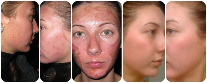 Peeling visage corail. Qu'est-ce que c'est, photos avant et après, résultats