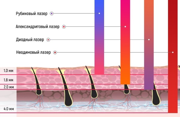 Laser Neodymium để tẩy lông mặt và cơ thể. Ảnh trước và sau, giá cả, đánh giá