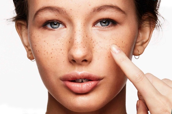 Remove pigmentation on the face at home quickly. Creams, folk remedies