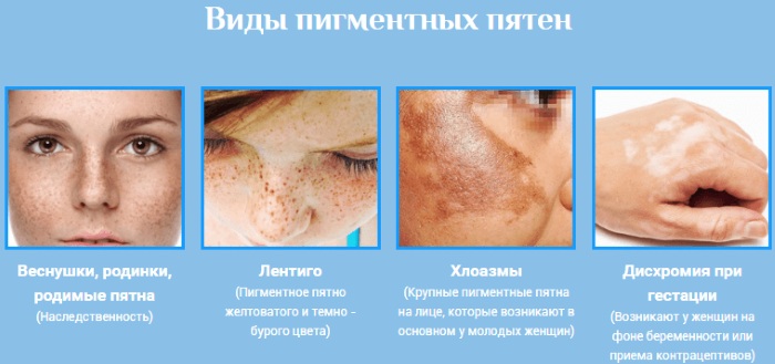 Élimine rapidement la pigmentation du visage à la maison. Crèmes, remèdes populaires