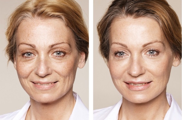 Blanchering i kosmetologi. Bilder före och efter, vad är det, teknik, pris, recensioner
