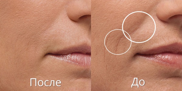 Blanchering i kosmetologi. Bilder før og etter, hva er det, teknikk, pris, anmeldelser