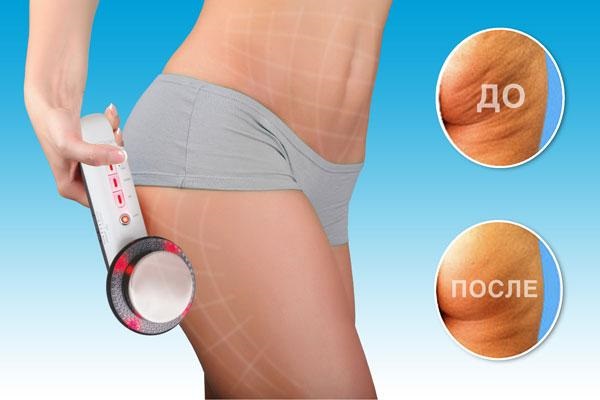 Anti-cellulite body massagers: manual, electric. Which is better, reviews