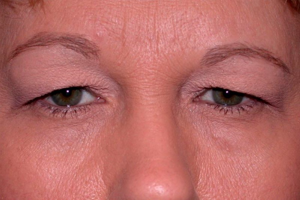 Chirurgische und nicht-chirurgische Augenlidstraffung. Zirkuläre Blepharoplastik, Mesothreads, Laser, Botox. Fotos, Preise