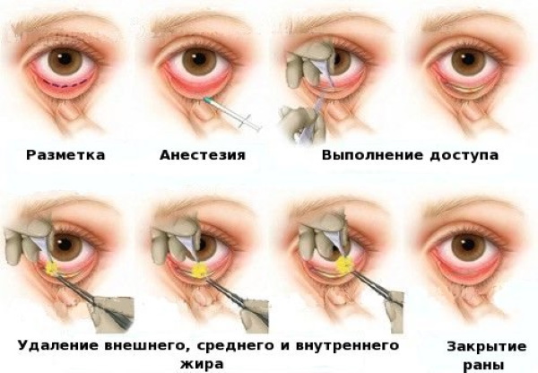 Peningkatan kelopak mata pembedahan dan bukan pembedahan. Blepharoplasty bulat, mesothreads, laser, botox. Foto, harga