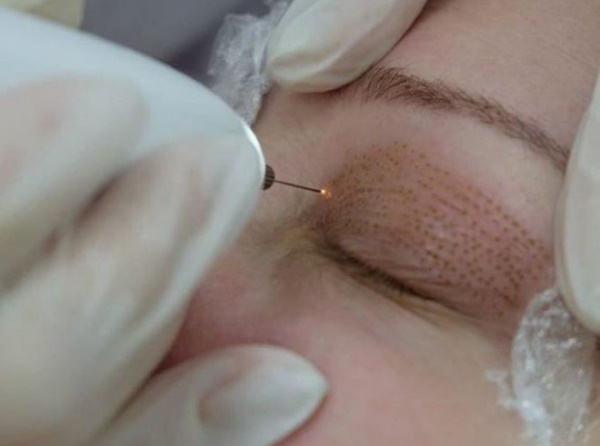 Chirurgische en niet-chirurgische ooglidlift. Circulaire ooglidcorrectie, mesothreads, laser, botox. Foto's, prijzen