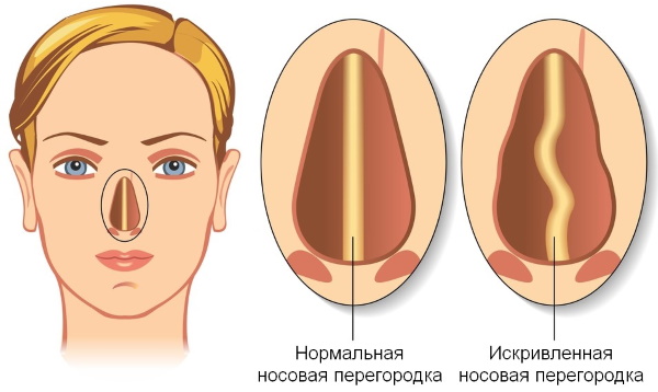Rinoplàstia del nas: tancada, oberta, reconstructiva, injecció, làser. Preu i ressenyes