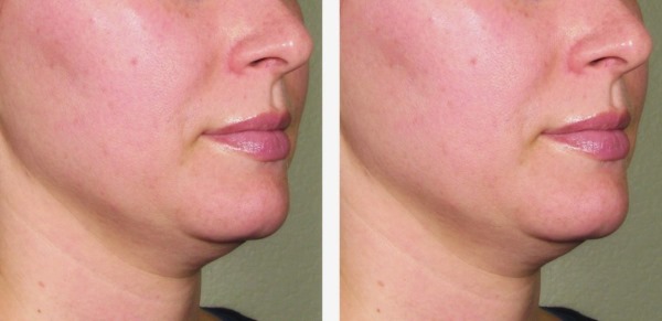 Terapie Ulthera (Altera) v hardwarové kosmetologii. Fotky před a po, cena, recenze
