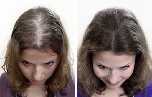 Spray d'Aleran contra la caiguda del cabell. Instruccions d'ús, ressenyes