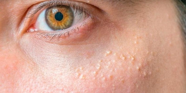 White spots under the eyes. What is it, the reasons for its appearance, how to get rid