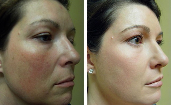 Erbium laser i kosmetologi. Bilder före och efter, applikationsresultat, recensioner