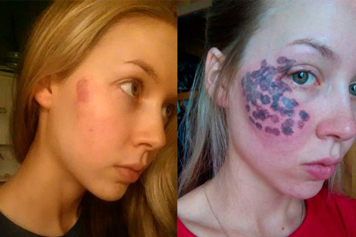 Laser facial en cosmétologie. Types, photos avant et après application, avis