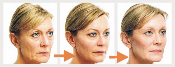 Tạo mặt cho khuôn mặt. Các bài tập hiệu quả, kỹ thuật chống bọng mắt, làm săn chắc vùng trái xoan, ảnh trước và sau