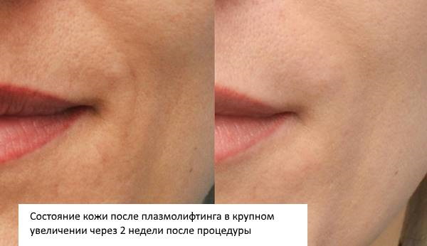 Plasmolifting của khuôn mặt. Đó là gì, hình ảnh trước và sau khi tiêm, chi phí nâng mũi plasma, đánh giá