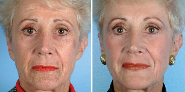 Resurfacing com diamante (limpeza) do rosto. Comentários, fotos antes e depois do peeling