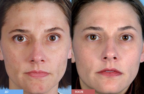 Yüzün elmas yüzeyinin yenilenmesi (temizlenmesi). Soyulmadan önce ve sonra incelemeler, fotoğraflar