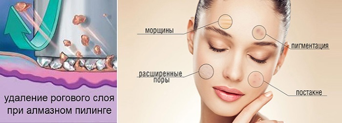 Diamentowe odnawianie (czyszczenie) twarzy. Recenzje, zdjęcia przed i po peelingu
