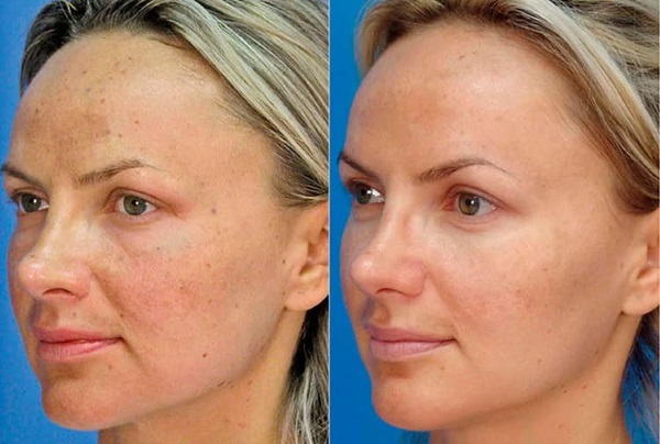 Diamond resurfacing (pulizia) del viso. Recensioni, foto prima e dopo il peeling