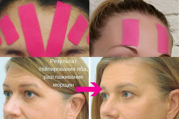How to glue tapes on your face correctly.Taping for wrinkles, bags under the eyes. A photo