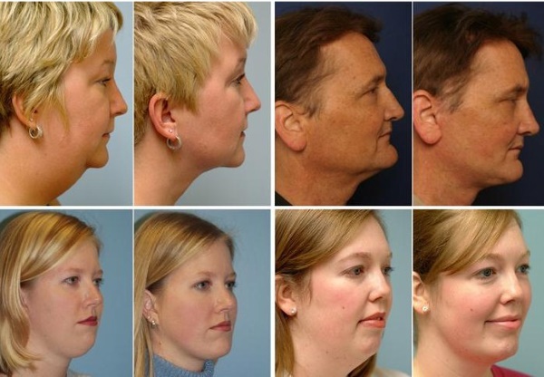 Ansigtskonturering fra den dobbelte hage. Fotos før og efter operationen, pris, anmeldelser