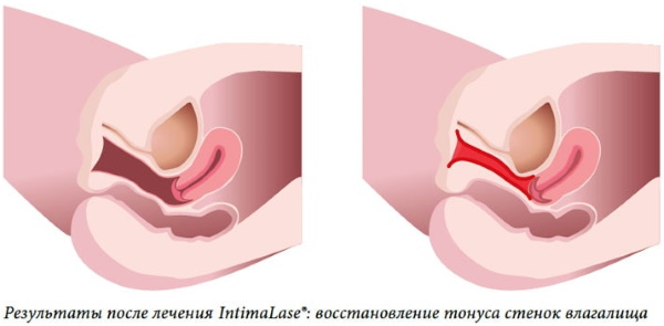 Ласерско подмлађивање вагине (вагинопластика након порођаја). Прегледи, цена