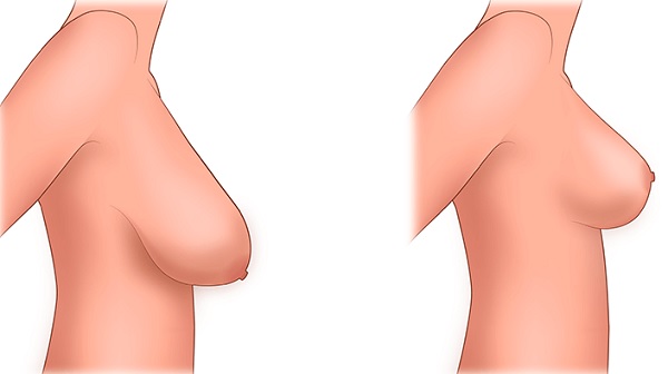 Dove ottenere la chirurgia plastica al seno. Prezzi, recensioni, foto prima e dopo