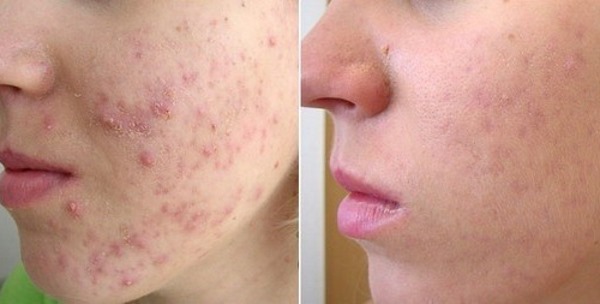 Fototerapia (fototerapia, fototerapia) da face. O que é, antes e depois das fotos, comentários, preço