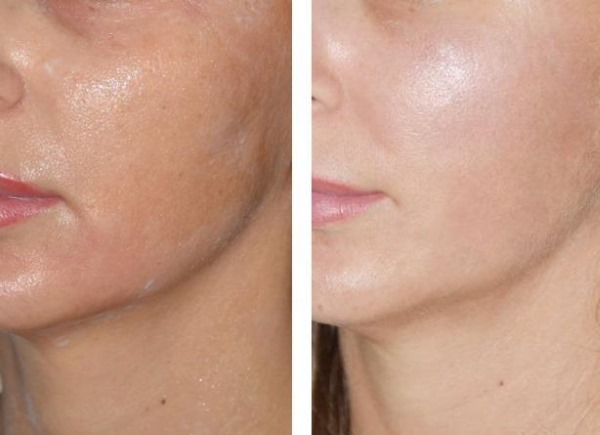 Fototerapi (terapi cahaya, terapi cahaya) wajah. Apa itu, sebelum dan selepas foto, ulasan, harga