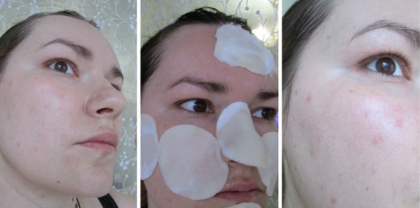 How to get rid of post acne at home. Means, cream, badyaga, peeling, scar correction, ointments