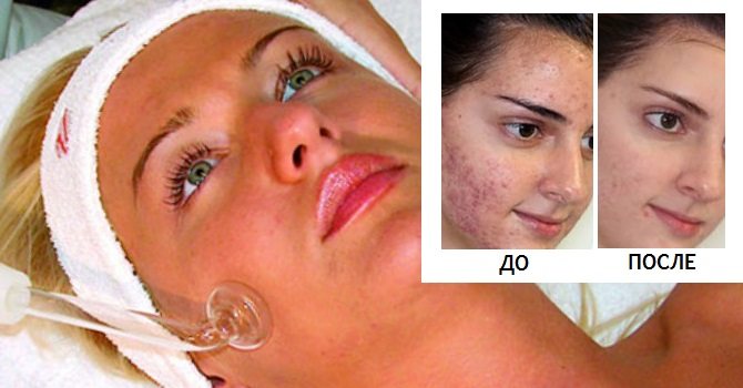 Cómo deshacerse del post acné en casa. Medios, crema, badyaga, peeling, corrección de cicatrices, ungüentos.