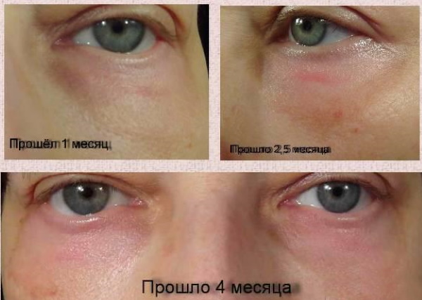 Laser mengembalikan permukaan kelopak mata (pseudoblepharoplasty). Harga, cara melakukannya, sebelum dan selepas gambar