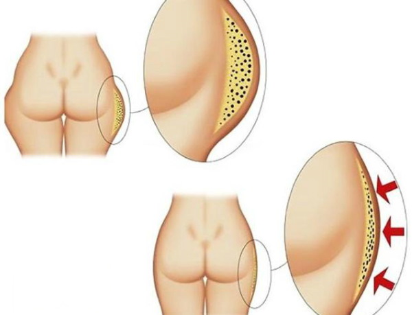 Fettabsaugung der Oberschenkel, dicke Beine bei Frauen. Vorher und nachher Fotos, Preis, Bewertungen