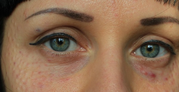 Gel meso (Mesoeye C71) per als ulls. Fotos abans i després, ressenyes, preu