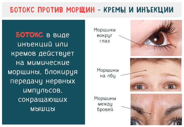 Botox-analoger för den ryska produktionen, Frankrike, Korea. Xeomin, Dysport, Relatox