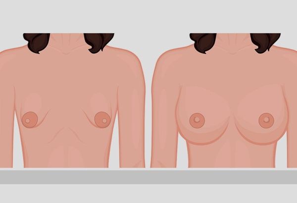 Forma tubulare di ghiandole mammarie, seno. Foto, correzione senza chirurgia per donne, uomini