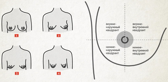 Forma tubulare di ghiandole mammarie, seno. Foto, correzione senza chirurgia per donne, uomini