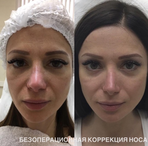 Redukcja nosa za pomocą lipolitów. Zdjęcia przed i po, cena, recenzje, konsekwencje