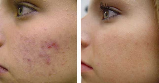Rengøring af en teenagers ansigt af en kosmetolog. Pris, anmeldelser