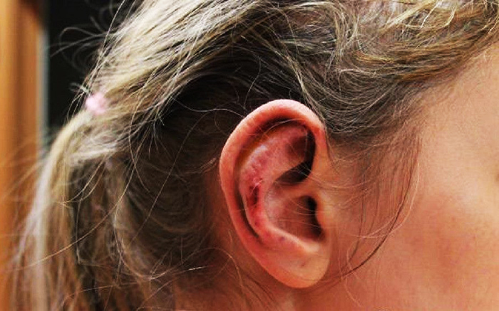 การผ่าตัดหูสำหรับ lop-earedness ราคาเท่าไหร่