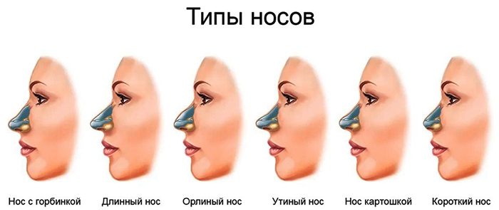 Las chicas tienen una nariz ancha. Qué hacer, cómo deshacerse de la rinoplastia.