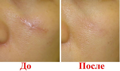 Eliminació de cicatrius làser a la cara. Ressenyes, fotos abans i després, preu