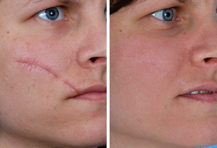 Entfernung von Lasernarben im Gesicht. Bewertungen, vor und nach Fotos, Preis