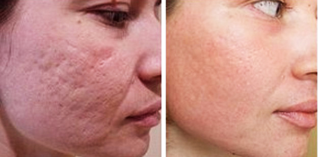 Élimination des cicatrices au laser sur le visage. Avis, photos avant et après, prix