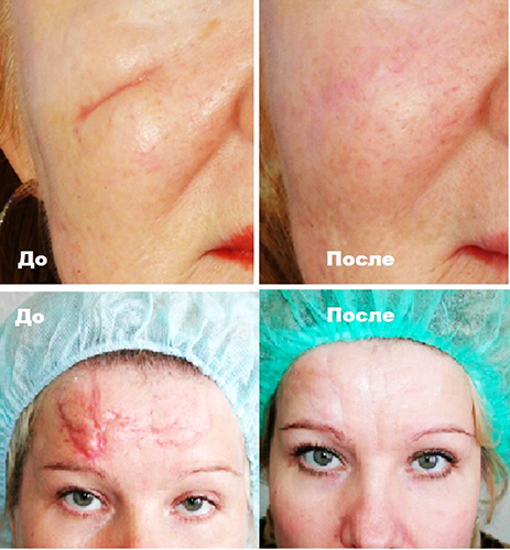 Αφαίρεση ουλής με λέιζερ στο πρόσωπο. Κριτικές, πριν και μετά τις φωτογραφίες, τιμή