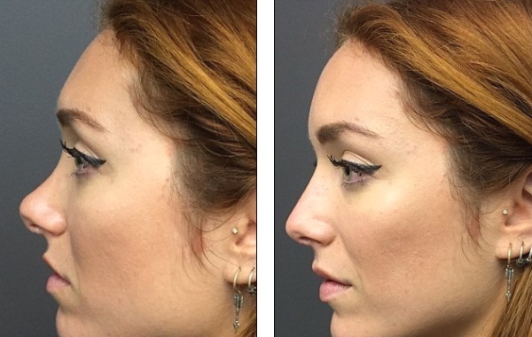 La niña tiene nariz chata. Cómo arreglar fotos de antes y después de la rinoplastia