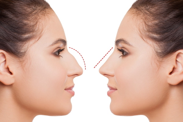 Djevojčica ima donji nos. Kako popraviti fotografije rinoplastike prije i poslije