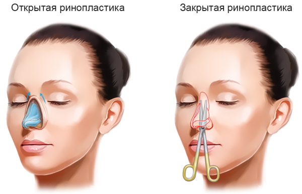 Девојчица има доњи нос. Како поправити фотографије ринопластике пре и после њих